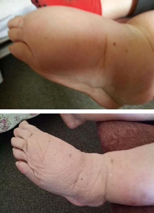 lymphoedema foot before after