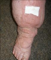 secondary lymphedema