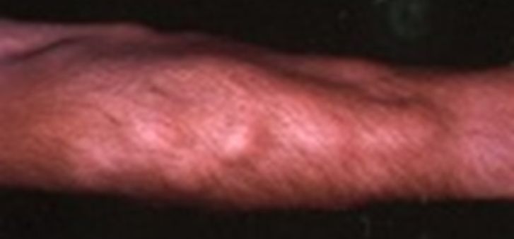 Dercum's Disease Picture