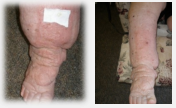 Lymphoedema Testimonial Picture 1